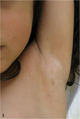 Axillary freckling. - By Serra G, Antona V, Corsello G, Zara F, Piro E, Falsaperla R[2] - CC-BY-SA 4.0