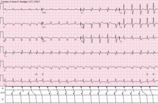 <span class="mw-page-title-main">Automatic tachycardia</span> Medical condition