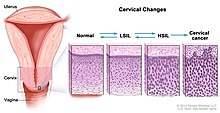 Prévention et dépistage du cancer du col utérin — Wikipédia