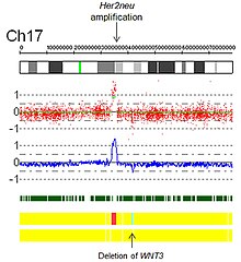 Fig 5. Her2 Amplification by SNP array virtual karyotype. Her2Neu.jpg