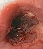 Herpeto esophagitis.JPG