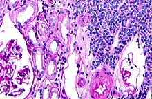 Micrograph of a metanephric adenoma, right of image, showing the characteristic features (round nuclear membrane, no nucleoli, and fine chromatin). Normal kidney is seen on the left of the image. Kidney biopsy. PAS stain. Metanephric adenoma high mag cropped.jpg