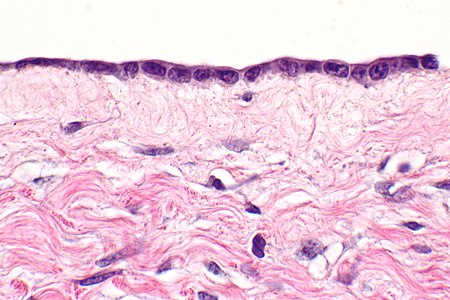 Ovarian serous cystadenoma -- extremely high mag.jpg