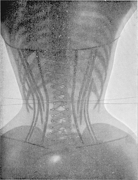 x-ray of a corset