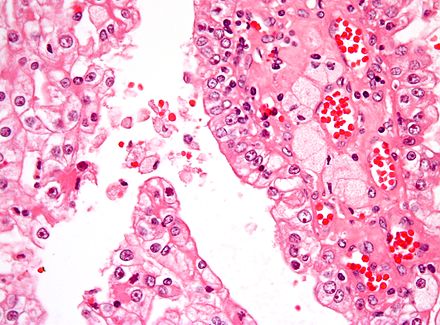 Micrograph of papillary renal cell carcinoma, a form of kidney cancer. H&E stain.