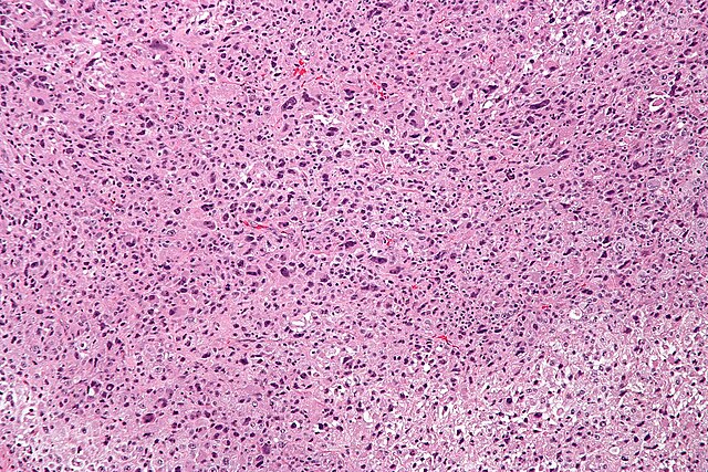 Description de l'image Pleomorphic undifferentiated sarcoma - intermed mag.jpg.