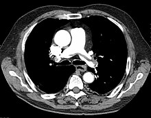 "Saddle" embolism on CT. The filling defect in the pulmonary artery is the clot. Pulmonary Embolism.jpg