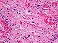 Histopathology of Rosenthal-fibres. H&E staining showing these elongated eosinophilic structures in a case of pilocytic astrocytoma. Magnification 400x