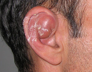 A seroma causing inflammation in part of the outer ear above the external auditory meatus.