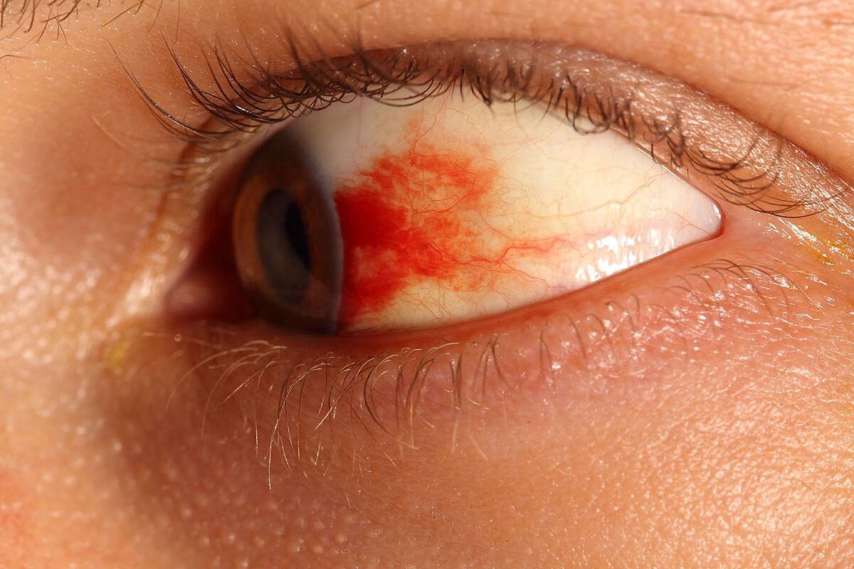 Subconjunctival hemorrhage eye.JPG