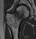 T1-weighted, turbo spin echo MRI of a 79-year-old woman's hip bones. The low signal areas of the image are due to bone marrow edema. T1 TSE MRI of hip fracture.jpg