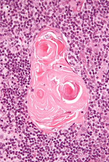 File:Thymic corpuscle.jpg