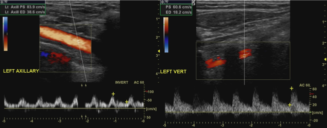 Doppler ultrasound of subclavian steal phenomenon