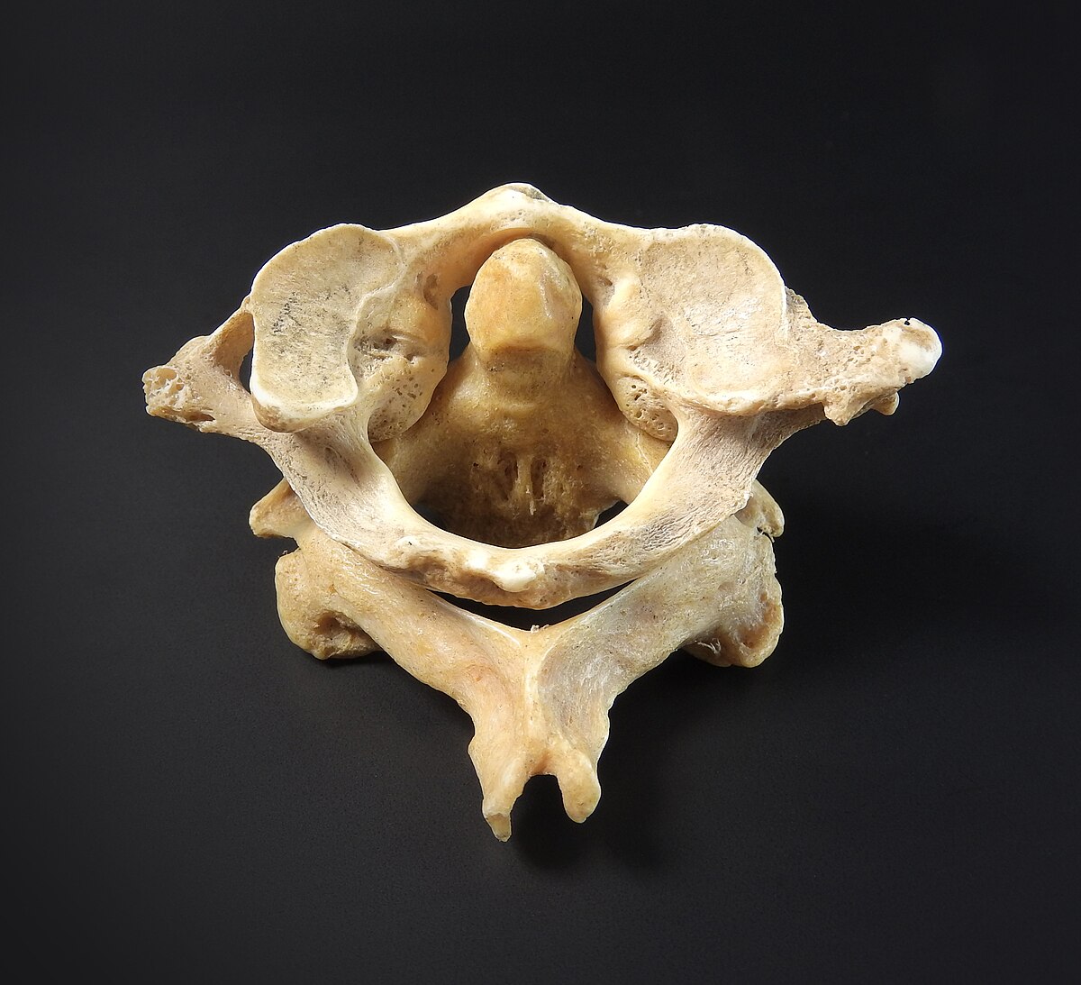 Fichier:Vertebra - atlas, axis (superior).jpg — Wikimedica