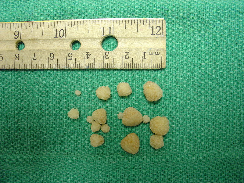 File:Calcium oxalate stones.JPG