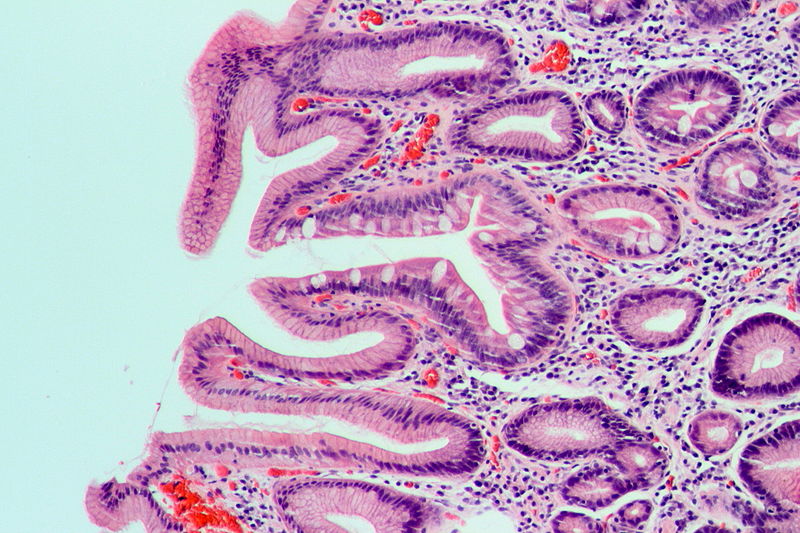 File:Complete intestinal metaplasia in a case of chronic gastritis, HE 1.jpg