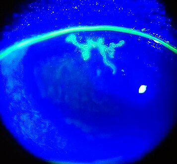 Dendritic corneal ulcer after fluorescein staining