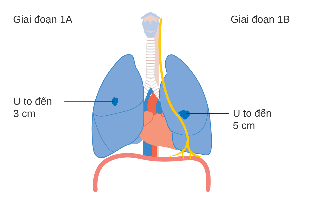 Thông tin về ung thư phổi giai đoạn 1a