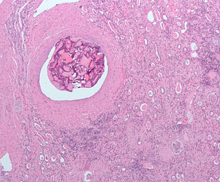 Embolism disease of arteries, arterioles and capillaries