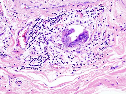 Gallbladder adenocarcinoma lymphatic invasion histopathology