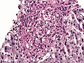 Histoplasma در granuloma. پاس diastase لکه.