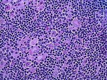 Hodgkin lymphoma, nodular lymphocyte predominant (high-power view): Notice the presence of L&H cells, also known as "popcorn cells". (H&E)