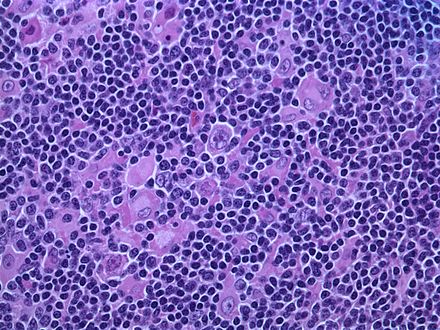 Hodgkin lymphoma, nodular lymphocyte predominant (high power view). Notice the presence of LP cells, also known as "popcorn cells". (H&E)