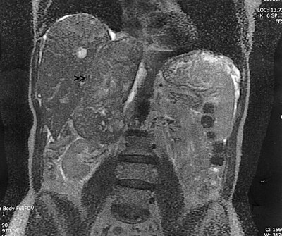 Leiomyosarcoma