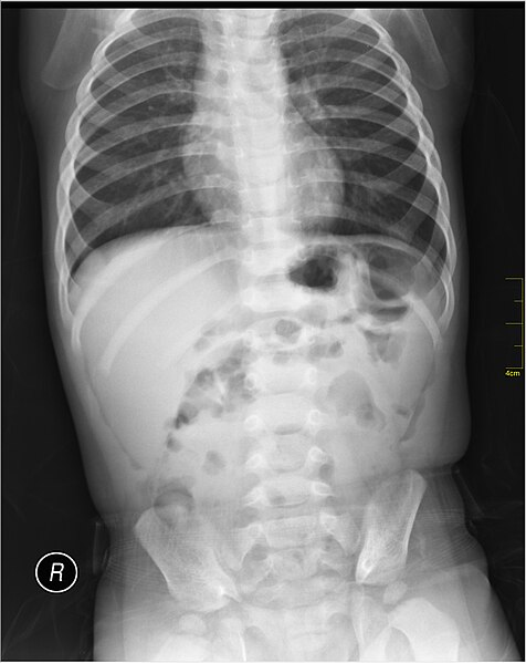 File:Medical X-Ray imaging QNJ06 nevit.jpg