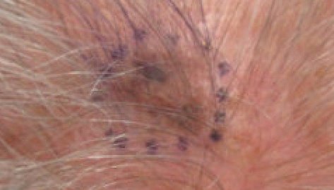 Melanoma in situ, vertex scalp marked for biopsy (Original Post: Shared in Melanoma)