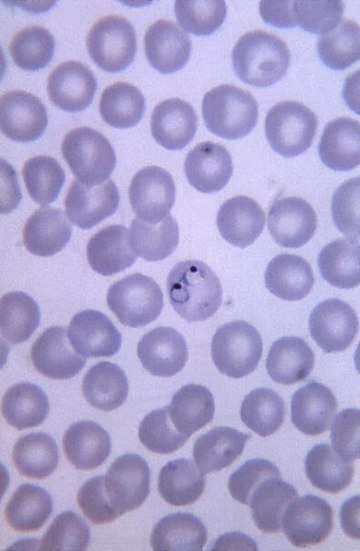 Malaria Suomessa