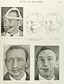 Photographs and diagrams showing plastic surgery to the face Wellcome L0050371.jpg