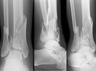 Pilon fracture Medical condition