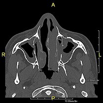 Axial CT image showing chronic sinusitis in an individual with Kartagener syndrome