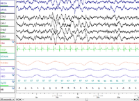 Polysomnography - Wikipedia