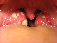 http://upload.wikimedia.org/wikipedia/commons/thumb/9/95/Tonsillitis.jpg/200px-Tonsillitis.jpg