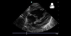 4 month old with pulmonary hypertension as seen on ultrasound[56]