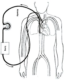 Veno-arterial (VA) ECMO for cardiac or respiratory failure.jpg