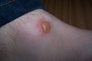 Blister.jpg