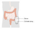 Diagram showing a colostomy with a bag CRUK 061.svg