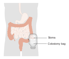 Diagram showing a colostomy with a bag CRUK 061.svg