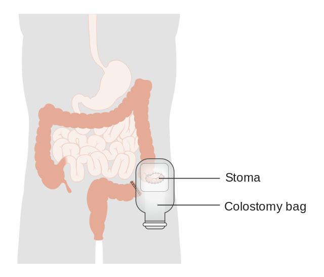 FAQs About Colostomy Bags