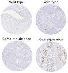 Immunohistochemistry for p53 can help distinguish a PUNLMP from a low grade urothelial carcinoma. Overexpression is seen in 75% of low-grade urothelial carcinomas and only 10% of PUNLMP. Expression of p53 in urothelial neoplasms.png