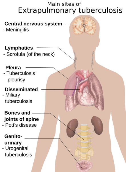 File:Extrapulmonary tuberculosis symptoms.svg