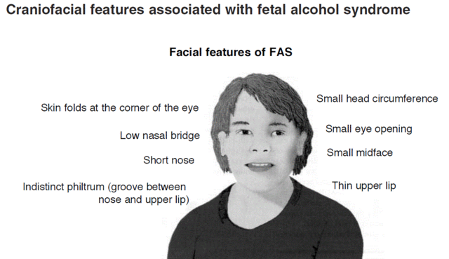 File:Zero alcool pendant la grossesse.svg - Wikipedia