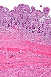 Gastrointestinal stromal tumour - intermed mag.jpg