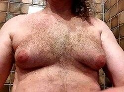 Gynecomastia - Wikipedia