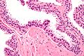 Neoplasia intraepiteliale prostatica di alto grado (PIN), colorazione con ematossilina-eosina, alto ingrandimento.