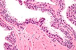 Thumbnail for High-grade prostatic intraepithelial neoplasia
