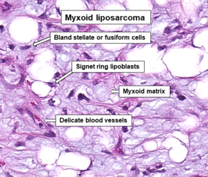 Histopathology of myxoid liposarcoma.png
